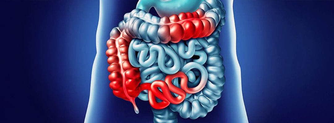 ¿Qué es la enfermedad de Crohn?: Síntomas, diagnóstico y tratamientos