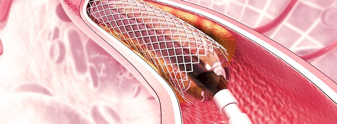 Angioplastia: una vía rápida y segura para tu corazón
